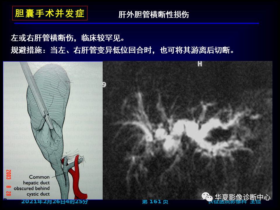 影像PPT - 【病例】坏死性胆囊炎1例MR影像-167