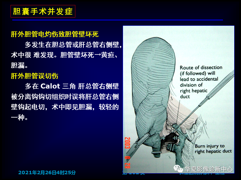 影像PPT - 【病例】坏死性胆囊炎1例MR影像-168