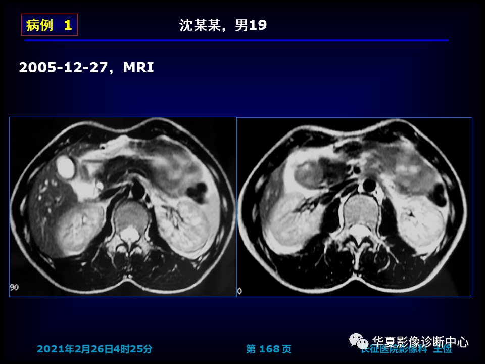 影像PPT - 【病例】坏死性胆囊炎1例MR影像-174
