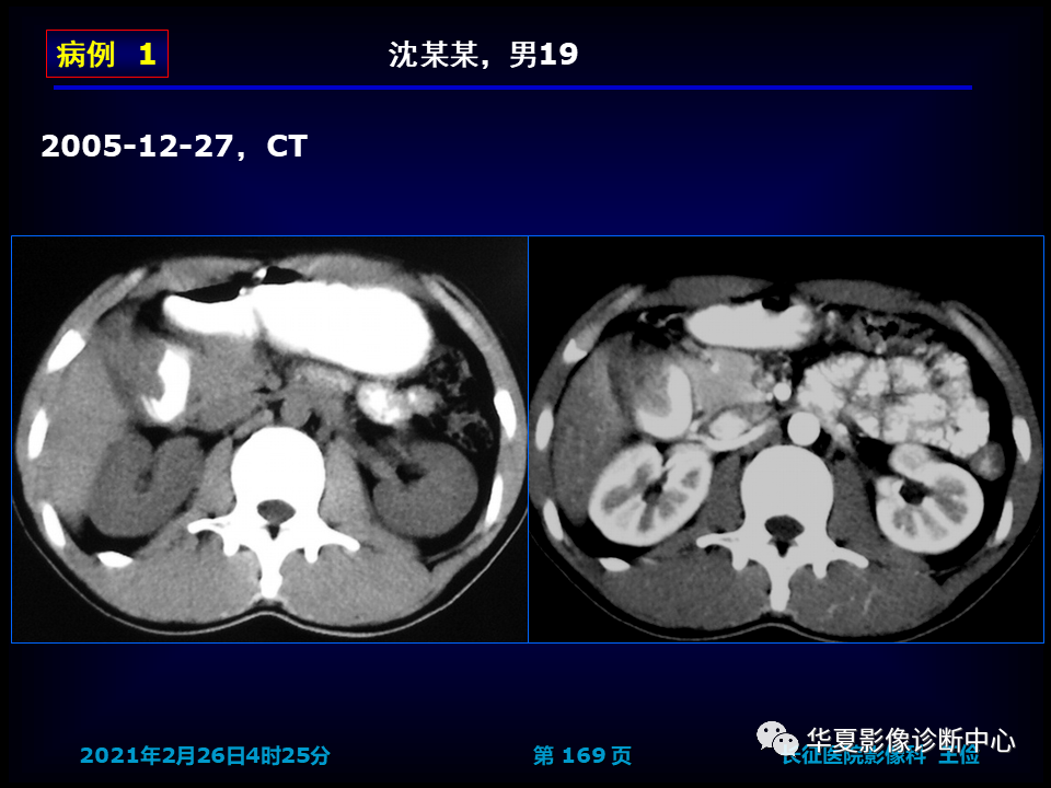 影像PPT - 【病例】坏死性胆囊炎1例MR影像-175
