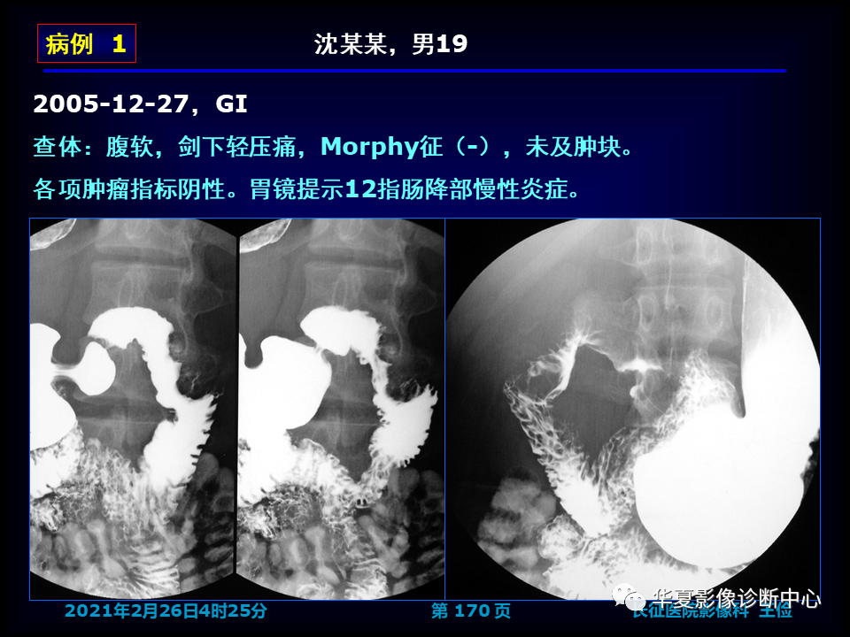 影像PPT - 【病例】坏死性胆囊炎1例MR影像-176