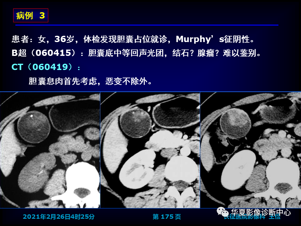 影像PPT - 【病例】坏死性胆囊炎1例MR影像-181
