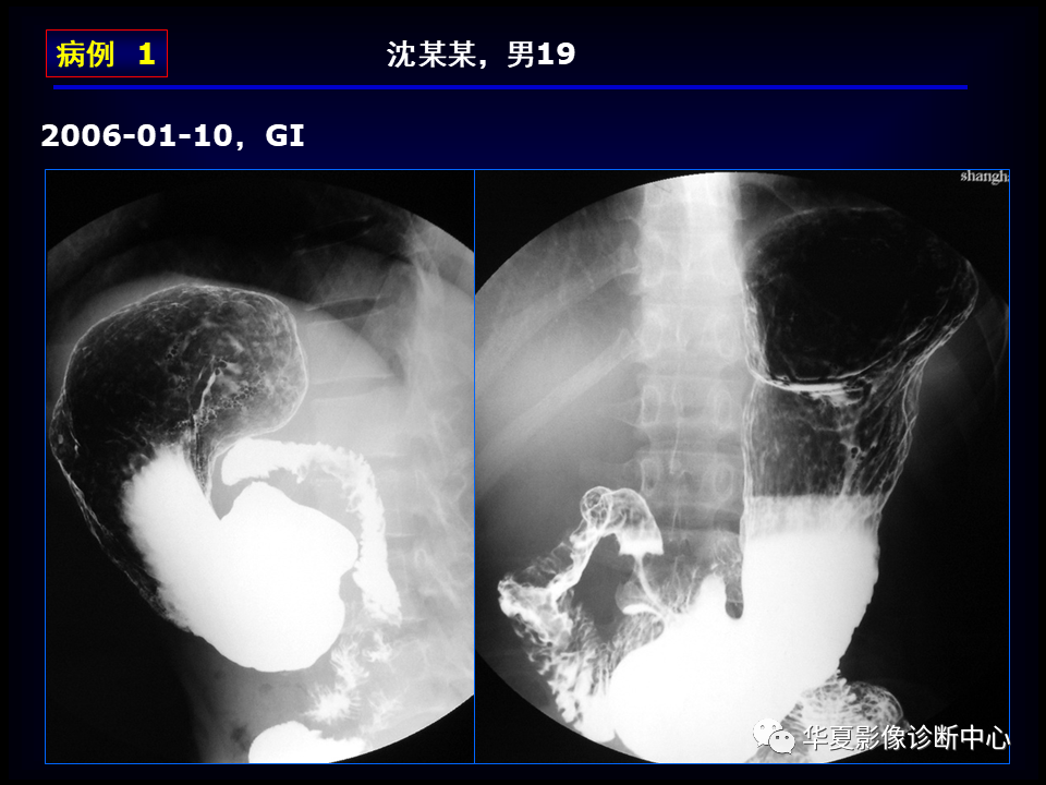 影像PPT - 【病例】坏死性胆囊炎1例MR影像-178