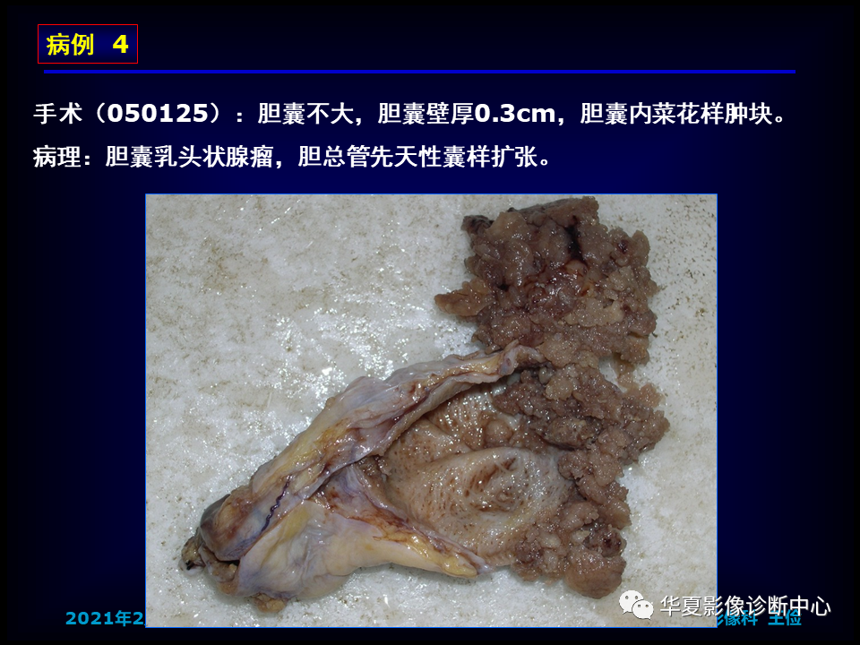 影像PPT - 【病例】坏死性胆囊炎1例MR影像-184