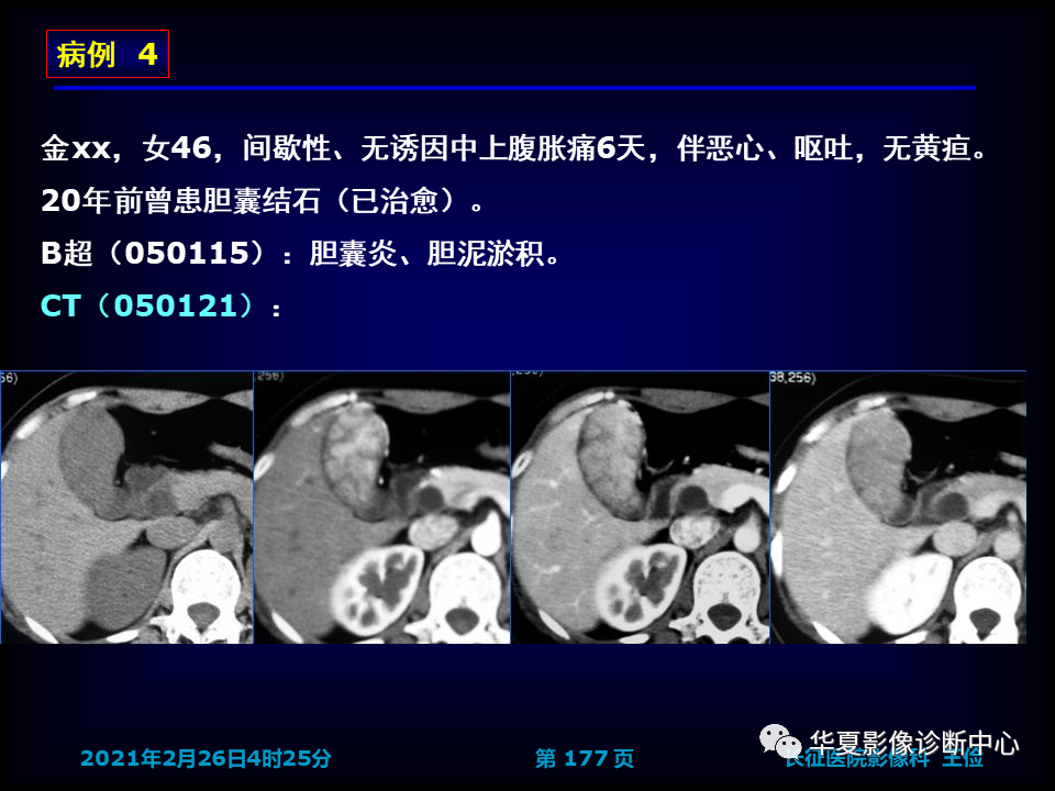 影像PPT - 【病例】坏死性胆囊炎1例MR影像-183