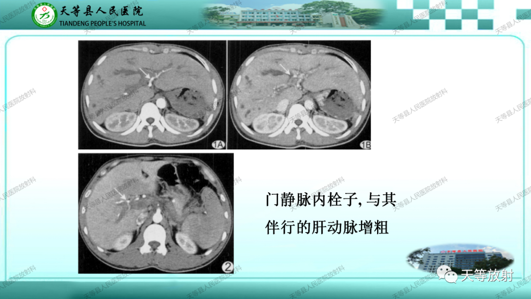 影像PPT - 【PPT】门静脉海绵样变性-19