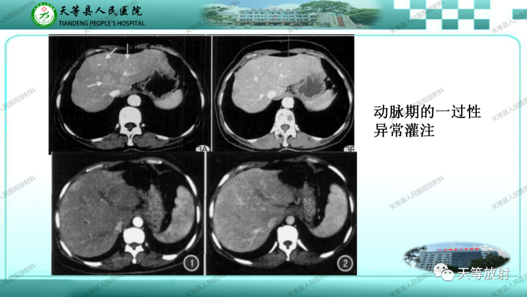 影像PPT - 【PPT】门静脉海绵样变性-20