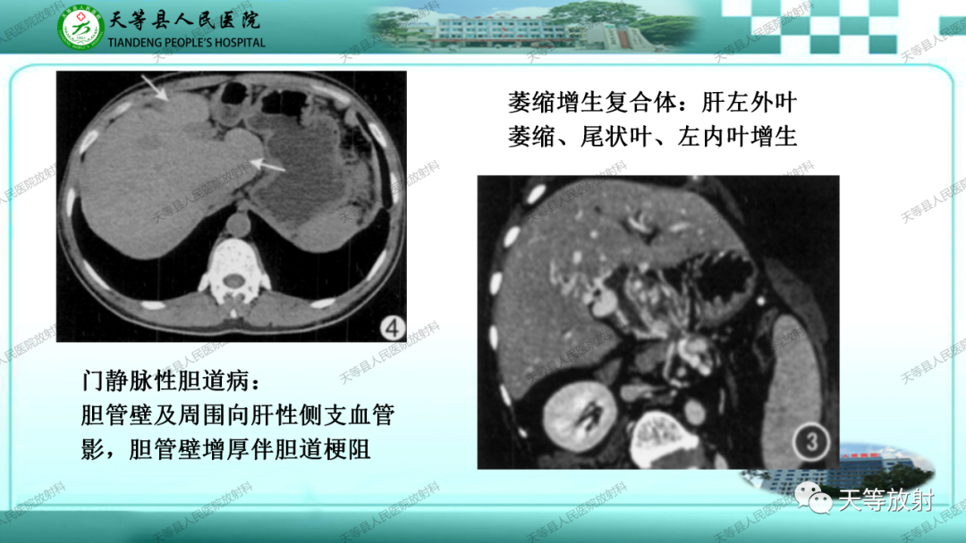 影像PPT - 【PPT】门静脉海绵样变性-21