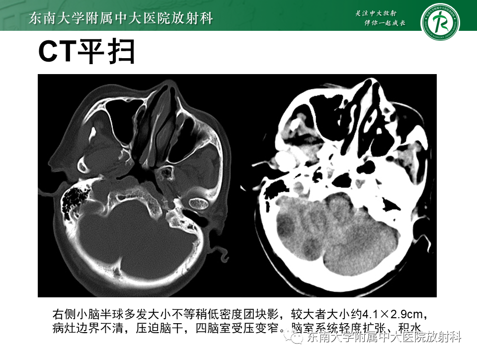 影像PPT - 【PPT】脑脓肿-3 影像PPT - 【PPT】脑脓肿-3