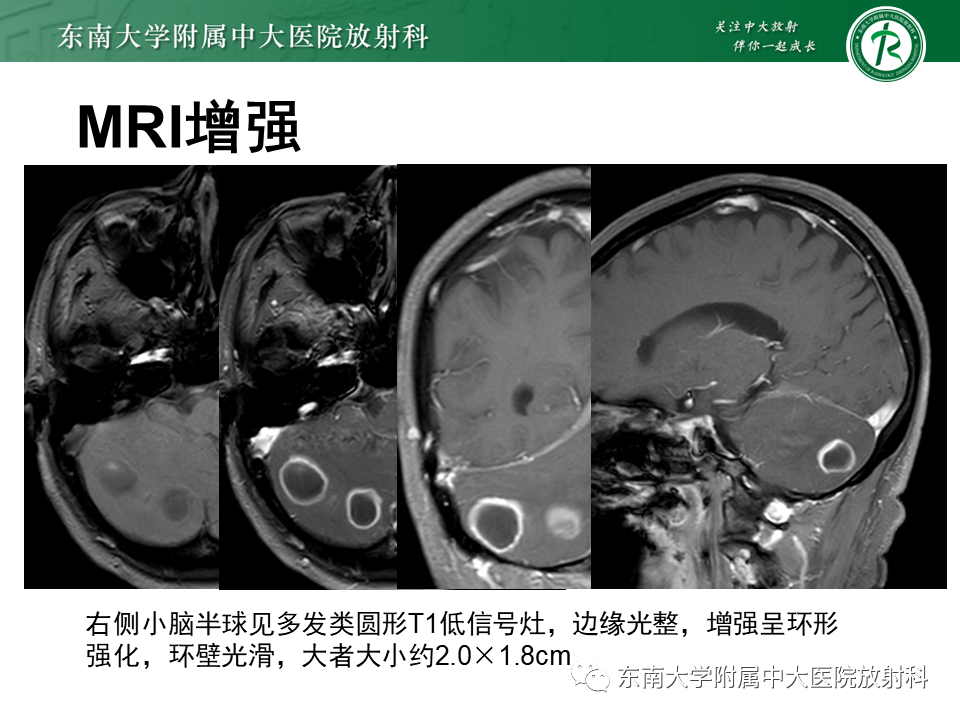影像PPT - 【PPT】脑脓肿-4 影像PPT - 【PPT】脑脓肿-4
