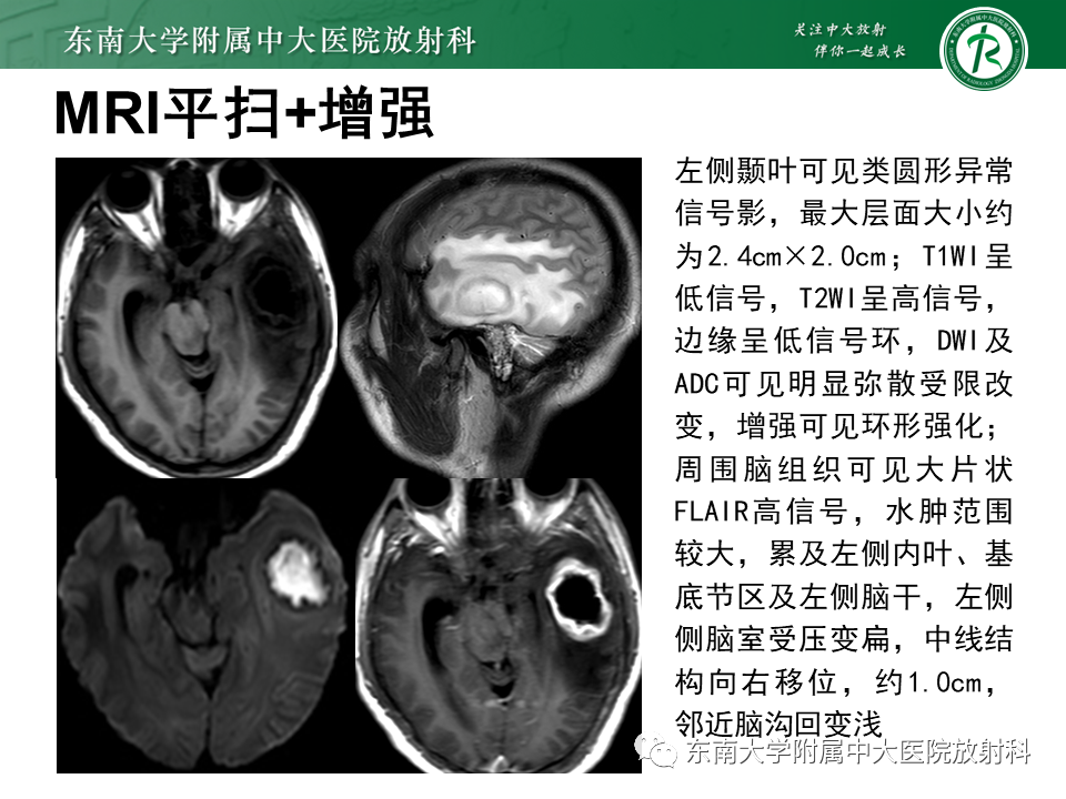 影像PPT - 【PPT】脑脓肿-14 影像PPT - 【PPT】脑脓肿-14