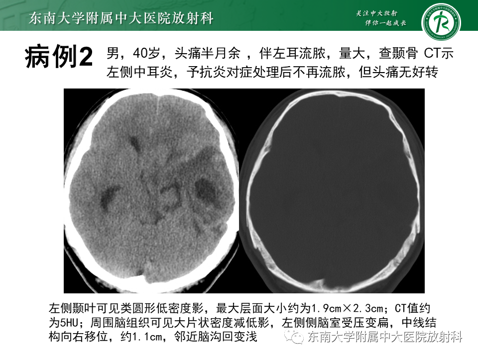 影像PPT - 【PPT】脑脓肿-13 影像PPT - 【PPT】脑脓肿-13