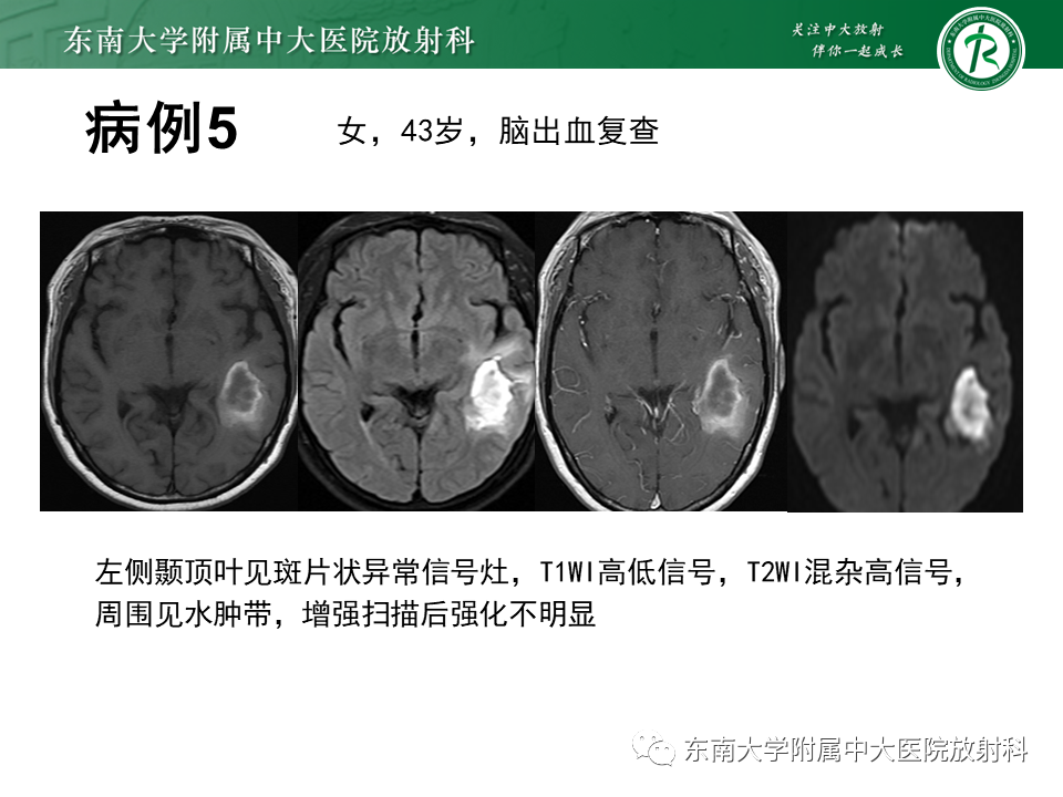 影像PPT - 【PPT】脑脓肿-21 影像PPT - 【PPT】脑脓肿-21