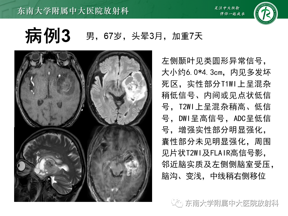 影像PPT - 【PPT】脑脓肿-17 影像PPT - 【PPT】脑脓肿-17