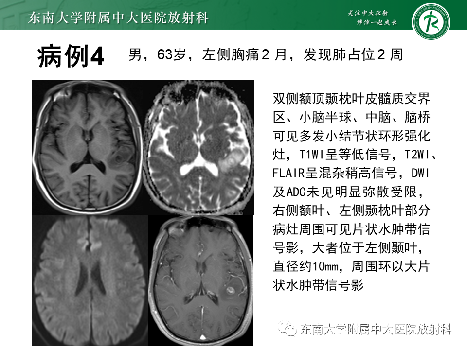 影像PPT - 【PPT】脑脓肿-19 影像PPT - 【PPT】脑脓肿-19