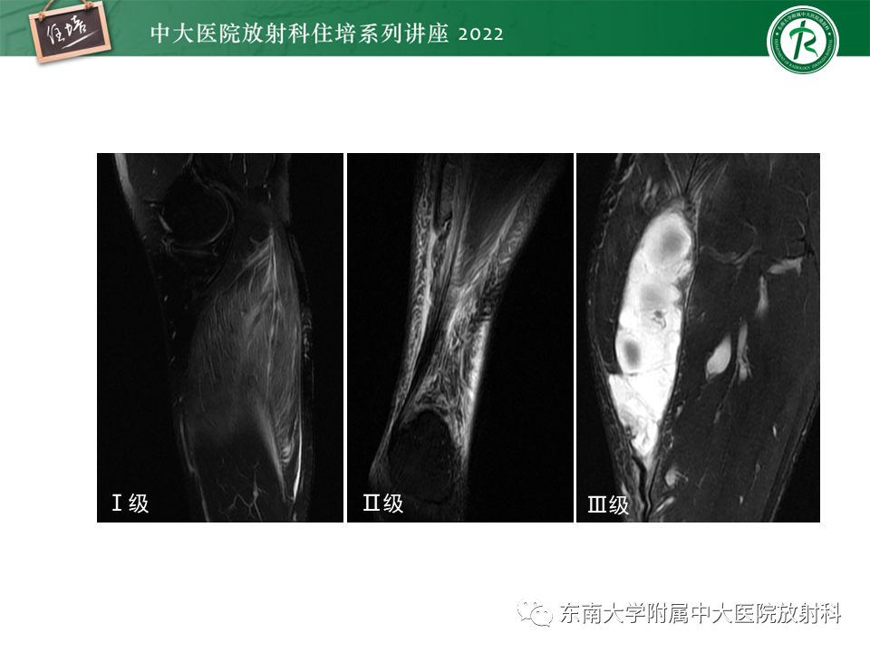 影像PPT - 【PPT】骨骼肌损伤的MR评估-7