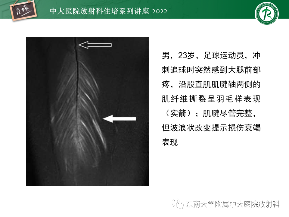 影像PPT - 【PPT】骨骼肌损伤的MR评估-8