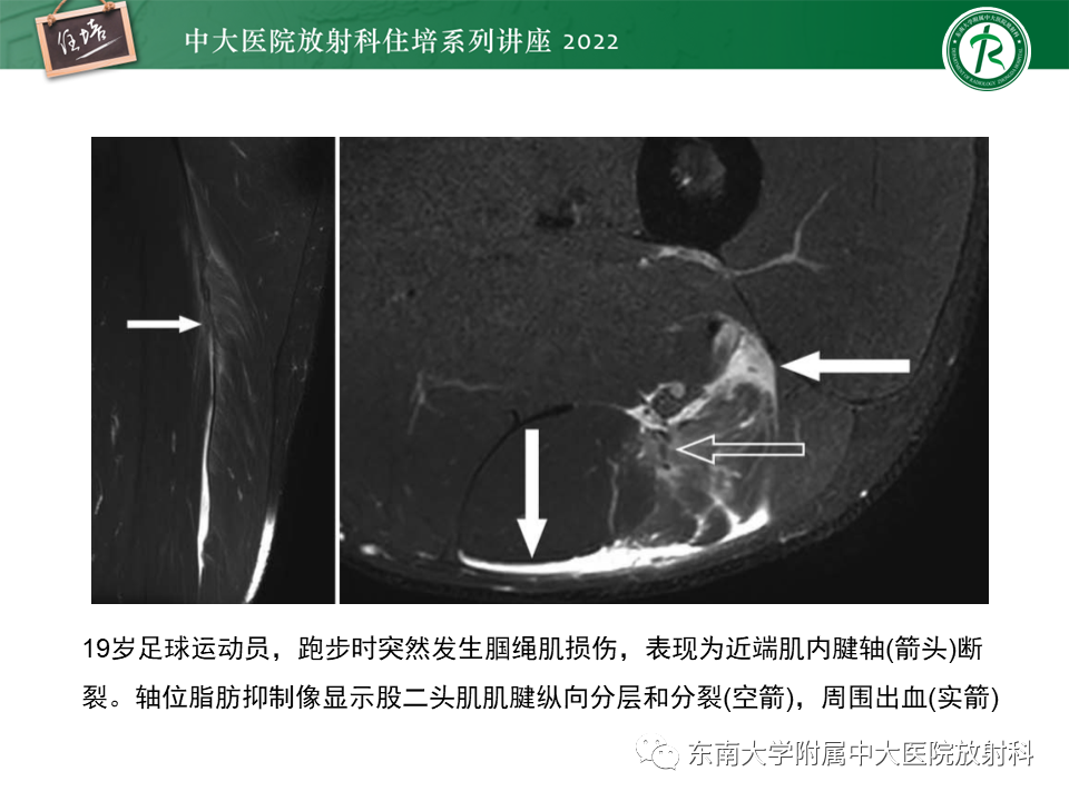 影像PPT - 【PPT】骨骼肌损伤的MR评估-10