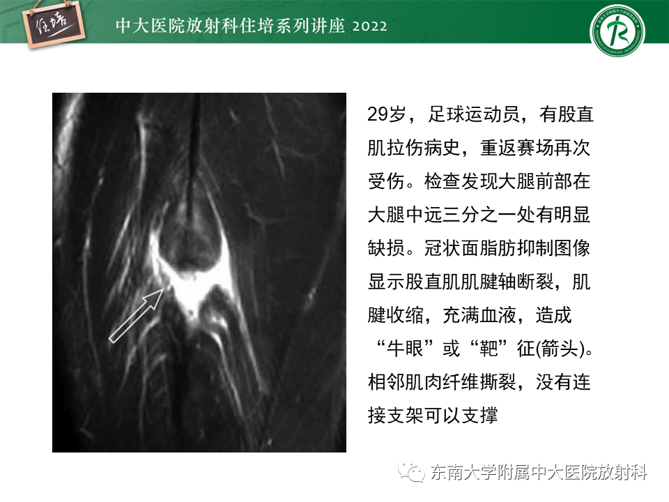 影像PPT - 【PPT】骨骼肌损伤的MR评估-11