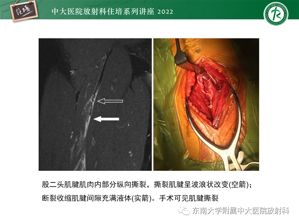 影像PPT - 【PPT】骨骼肌损伤的MR评估-9