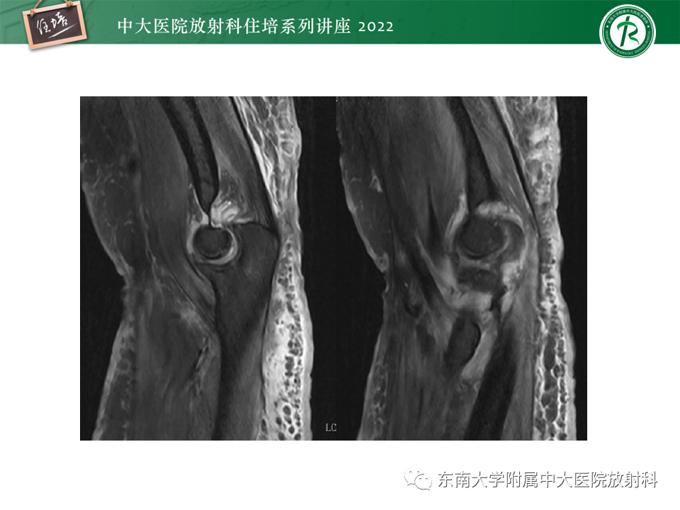 影像PPT - 【PPT】骨骼肌损伤的MR评估-14