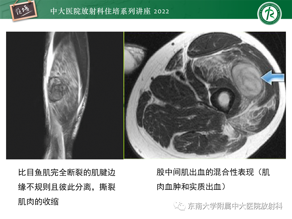 影像PPT - 【PPT】骨骼肌损伤的MR评估-16