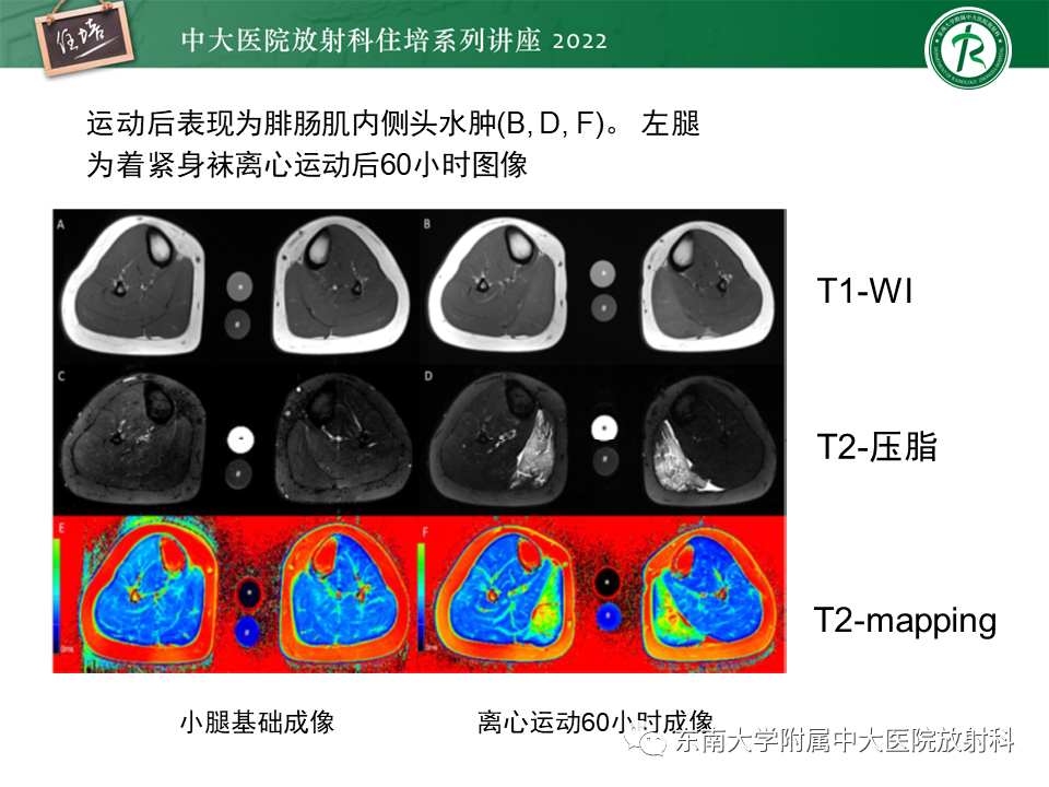 影像PPT - 【PPT】骨骼肌损伤的MR评估-26