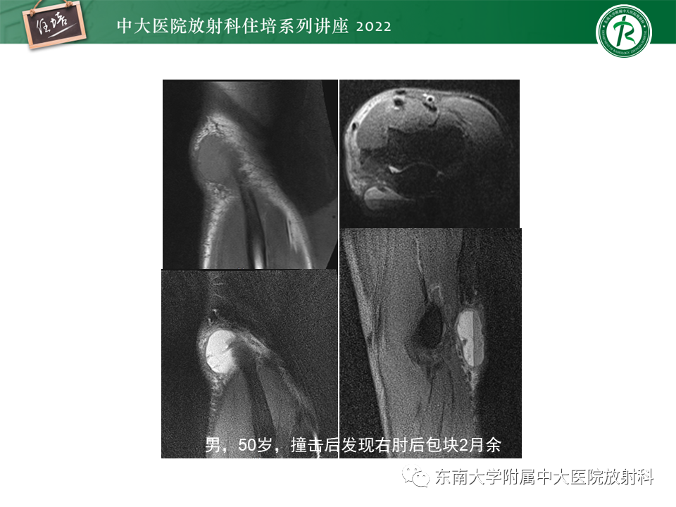 影像PPT - 【PPT】骨骼肌损伤的MR评估-20