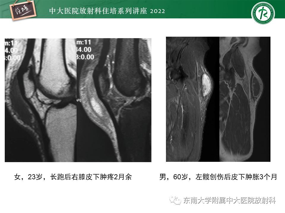 影像PPT - 【PPT】骨骼肌损伤的MR评估-21