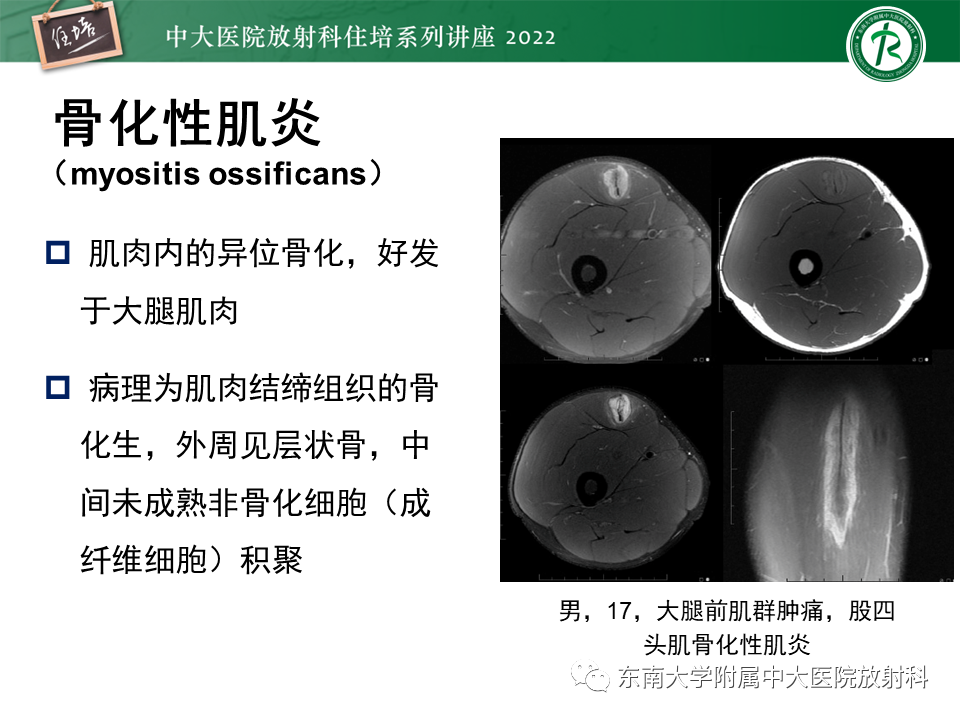 影像PPT - 【PPT】骨骼肌损伤的MR评估-32