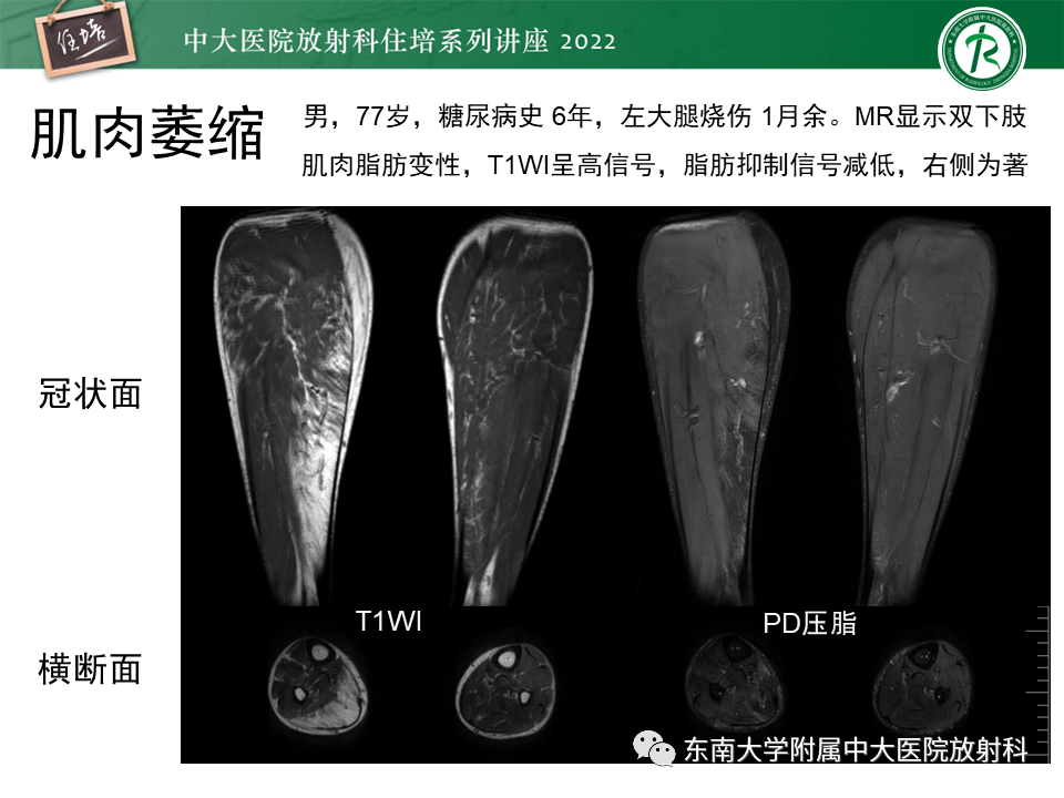 影像PPT - 【PPT】骨骼肌损伤的MR评估-31