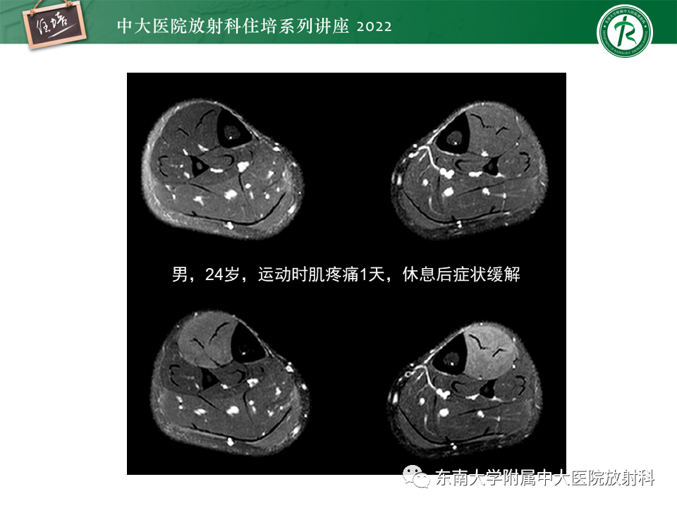 影像PPT - 【PPT】骨骼肌损伤的MR评估-34