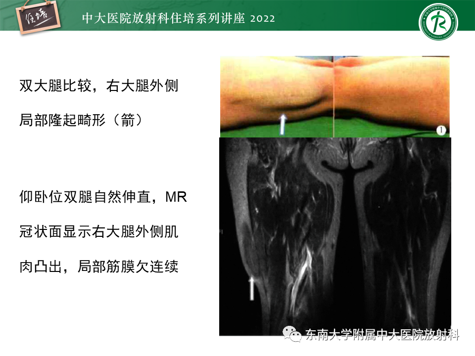 影像PPT - 【PPT】骨骼肌损伤的MR评估-36