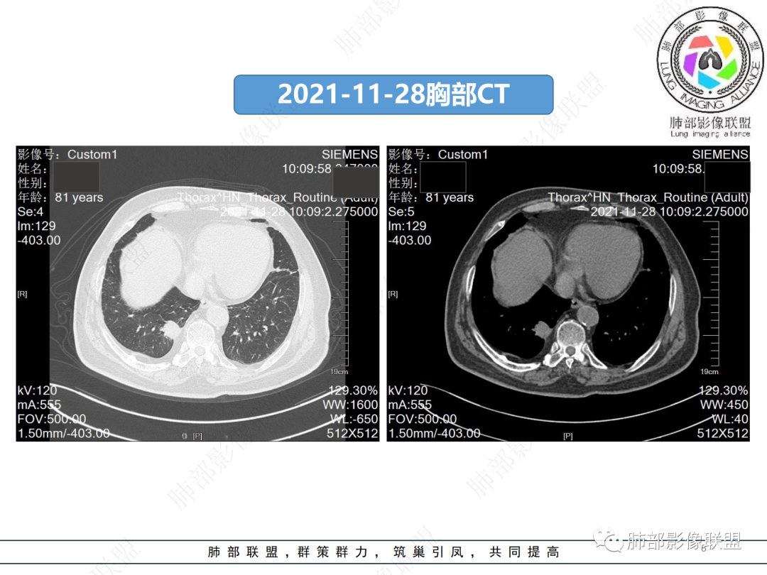 影像PPT - 【病例】肺孤立结节与曲霉菌感染-8 影像PPT - 【病例】肺孤立结节与曲霉菌感染-8