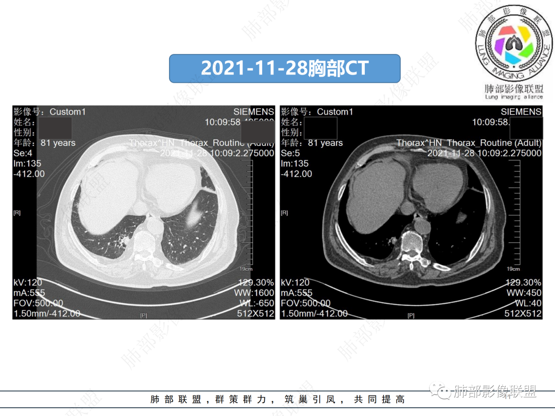 影像PPT - 【病例】肺孤立结节与曲霉菌感染-11 影像PPT - 【病例】肺孤立结节与曲霉菌感染-11