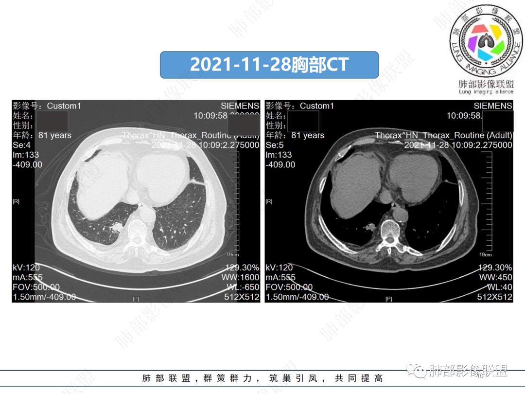 影像PPT - 【病例】肺孤立结节与曲霉菌感染-10 影像PPT - 【病例】肺孤立结节与曲霉菌感染-10