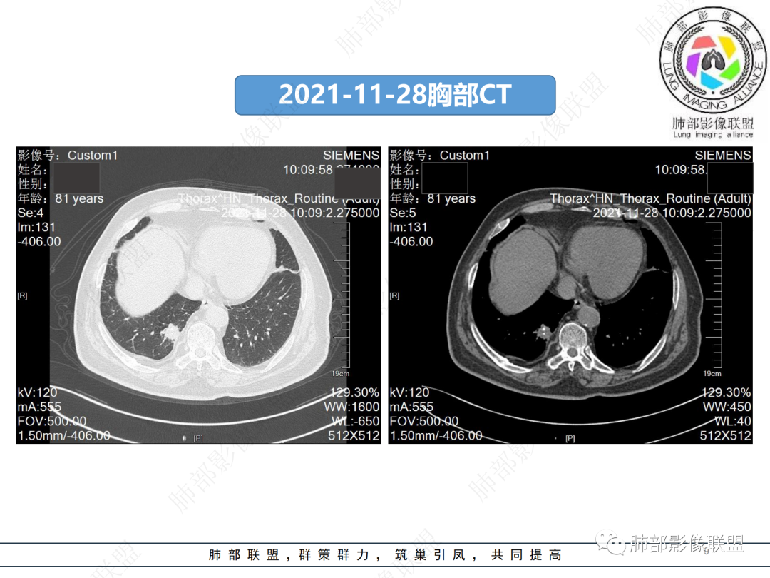 影像PPT - 【病例】肺孤立结节与曲霉菌感染-9 影像PPT - 【病例】肺孤立结节与曲霉菌感染-9