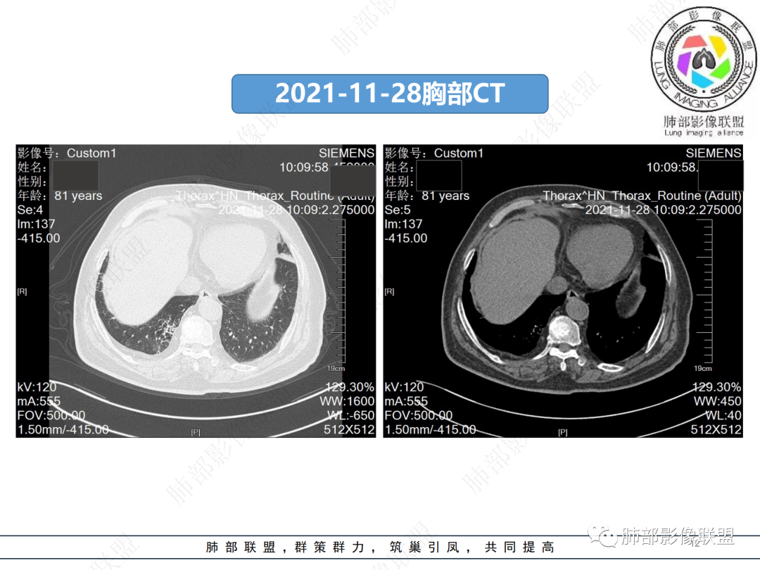 影像PPT - 【病例】肺孤立结节与曲霉菌感染-12 影像PPT - 【病例】肺孤立结节与曲霉菌感染-12