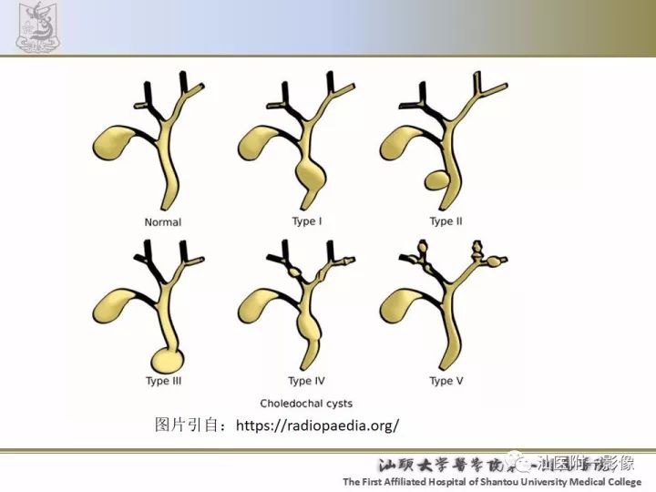 影像PPT - 【PPT】先天性胆总管囊肿影像学诊断-7