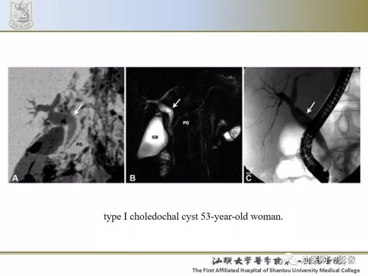 影像PPT - 【PPT】先天性胆总管囊肿影像学诊断-9