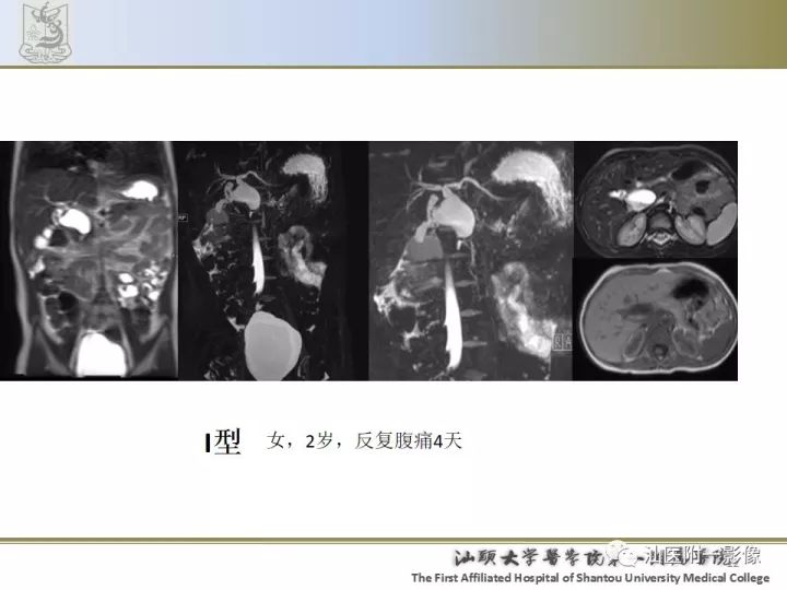 影像PPT - 【PPT】先天性胆总管囊肿影像学诊断-12