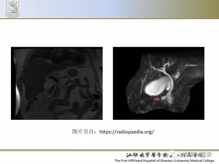 影像PPT - 【PPT】先天性胆总管囊肿影像学诊断-16