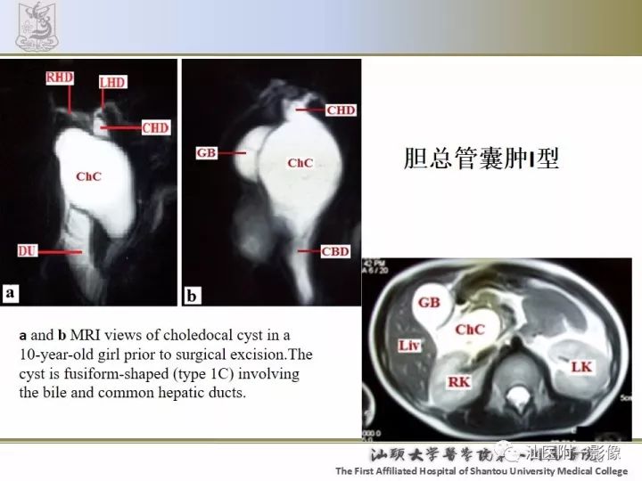 影像PPT - 【PPT】先天性胆总管囊肿影像学诊断-10