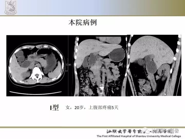 影像PPT - 【PPT】先天性胆总管囊肿影像学诊断-11