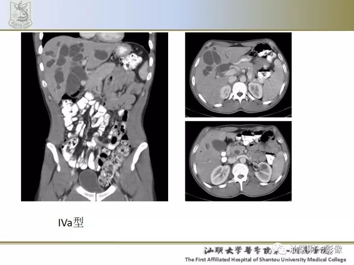 影像PPT - 【PPT】先天性胆总管囊肿影像学诊断-18