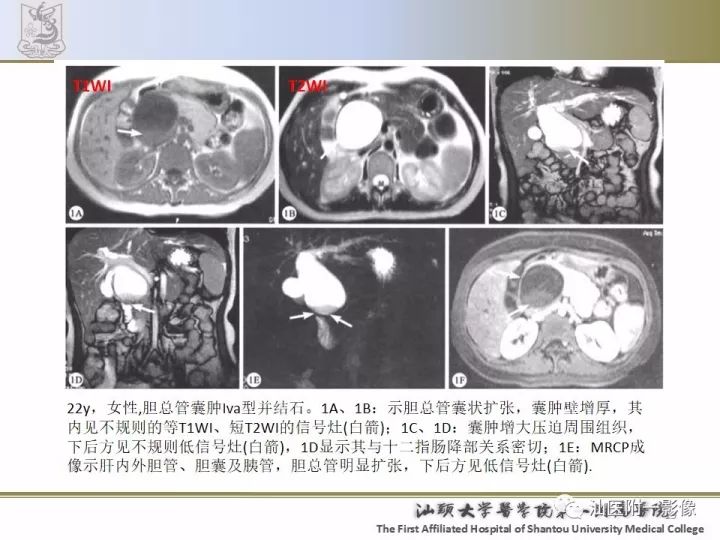 影像PPT - 【PPT】先天性胆总管囊肿影像学诊断-19