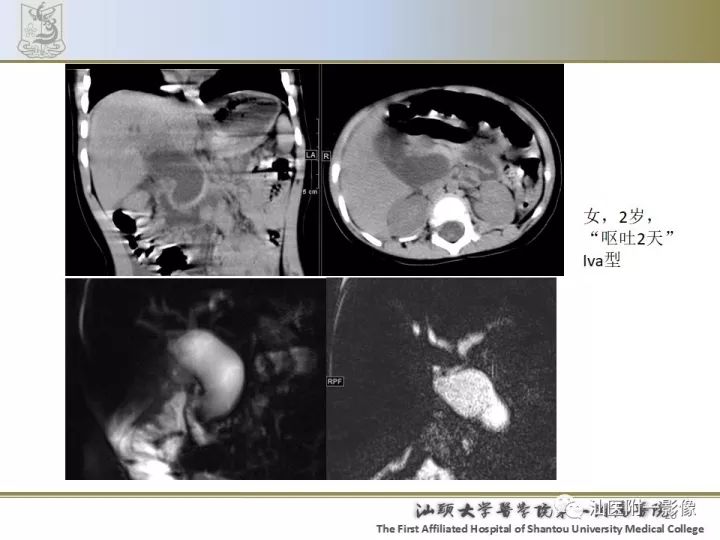 影像PPT - 【PPT】先天性胆总管囊肿影像学诊断-20