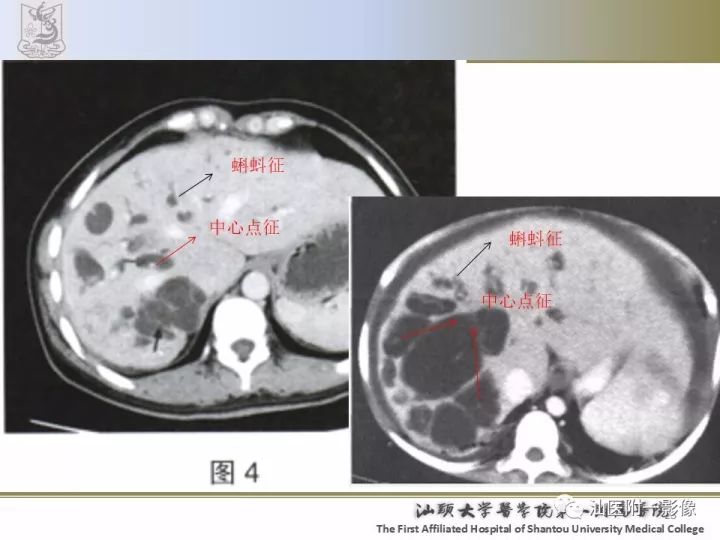 影像PPT - 【PPT】先天性胆总管囊肿影像学诊断-21