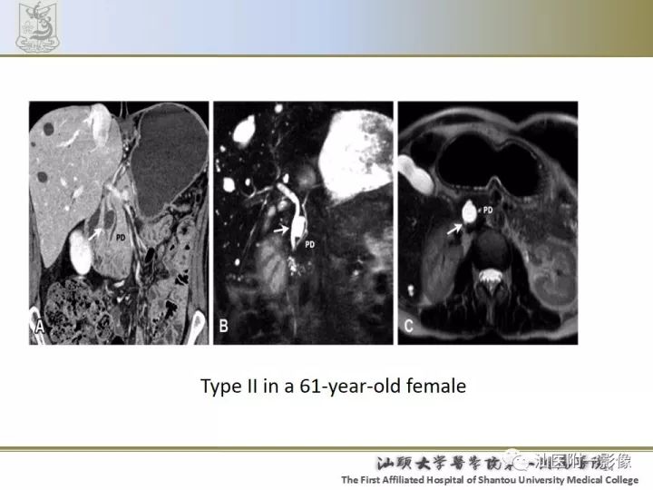 影像PPT - 【PPT】先天性胆总管囊肿影像学诊断-14