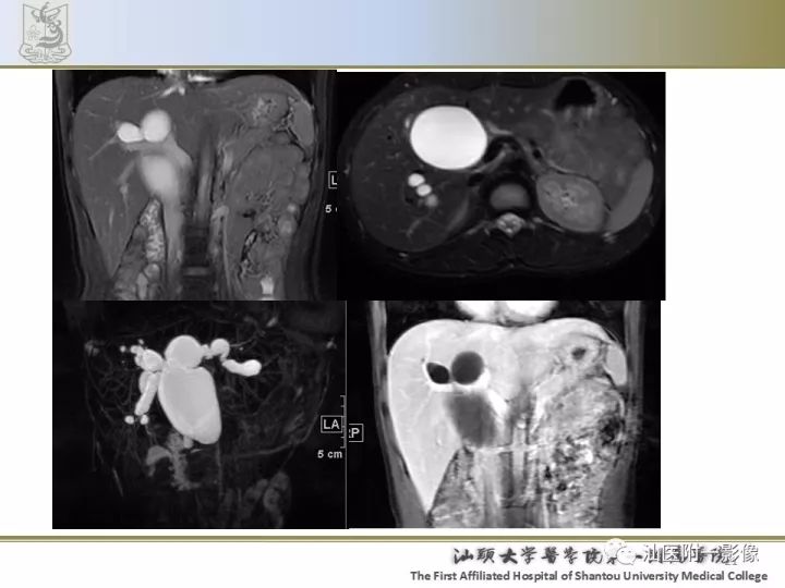 影像PPT - 【PPT】先天性胆总管囊肿影像学诊断-22